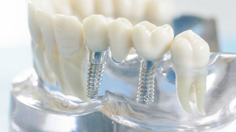 Как правильно ухаживать за зубами после имплантации