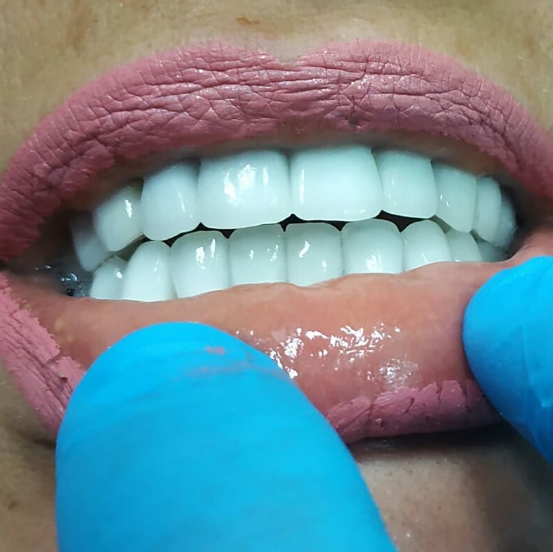 Отбеленные зубы