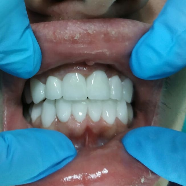 коронки на зубах