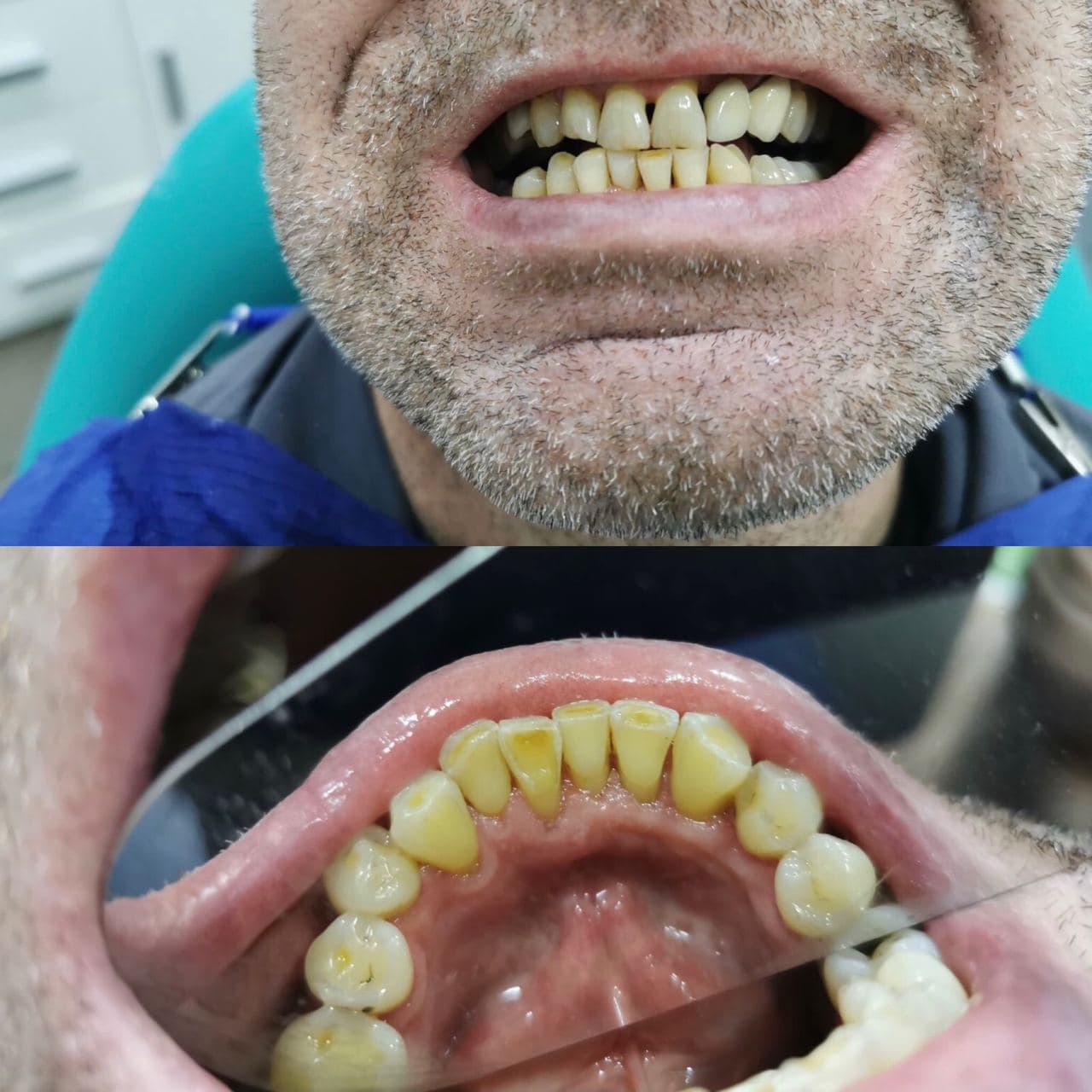 Зубы после чистки