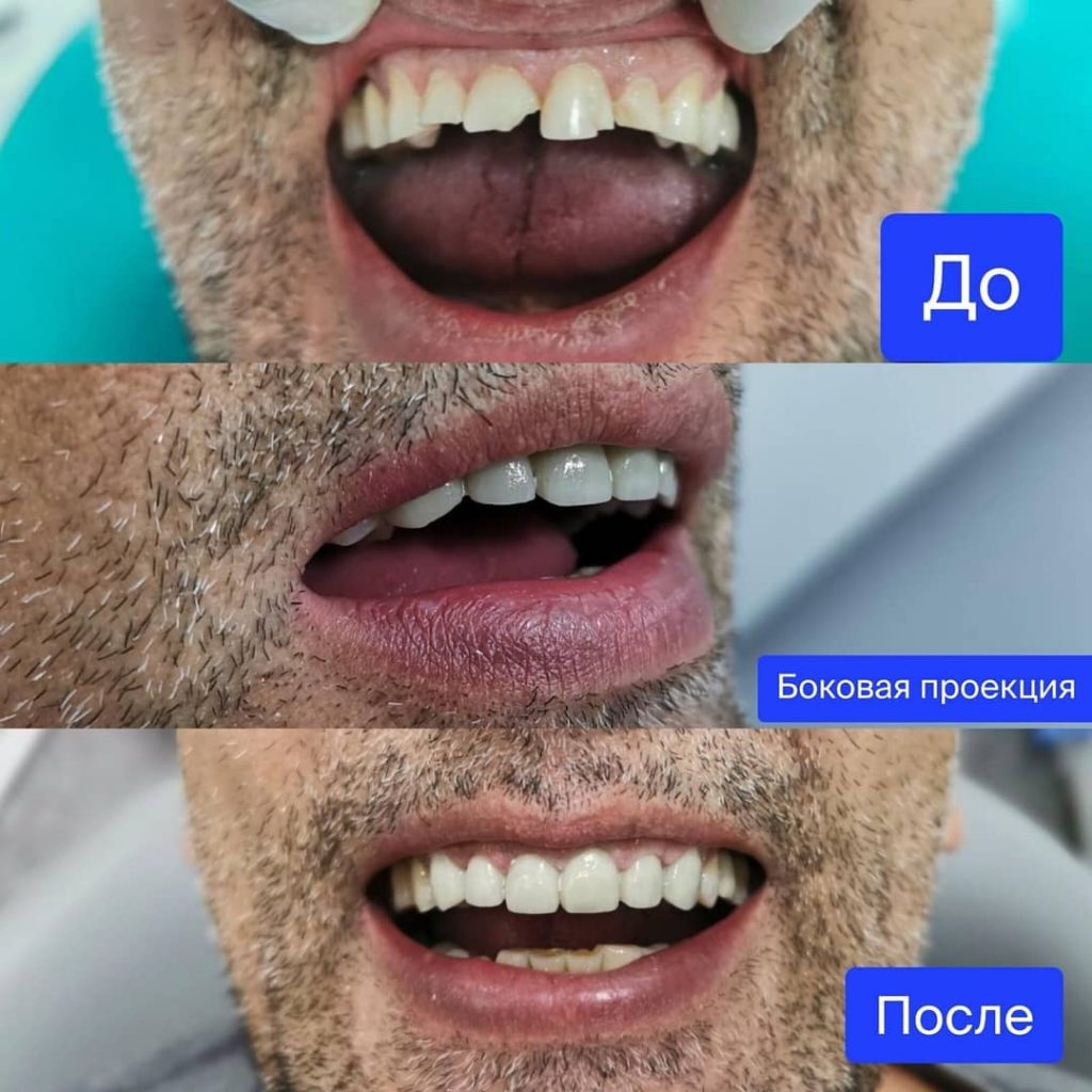 эффект-от-коронок
