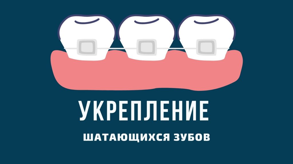 укрепление шатающихся зубов