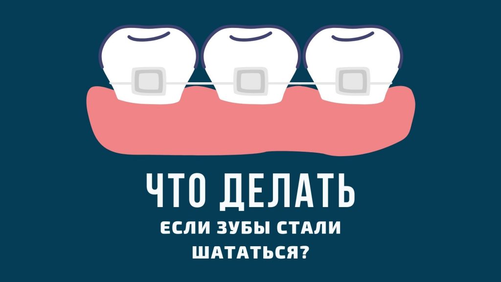 Что делать, если зубы стали шататься?