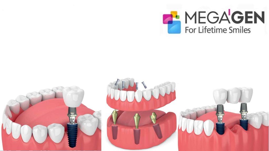 Импланты в китае. Импланты зубные МЕГАГЕН. Набор для имплантов Megagen. Зубные протезы на имплантах.