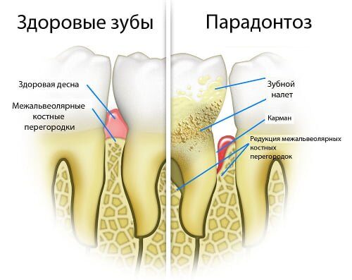 Пародонтолог - цены на пародонтологию в Одессе