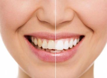 Эстетическая стоматология - отбеливание зубов в Одессе {{brizy_dc_image_alt imageSrc=